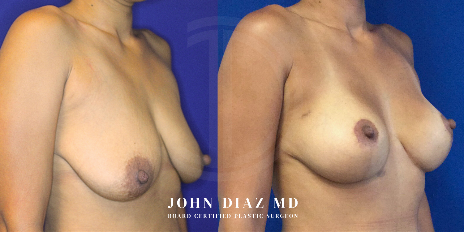 Dr John Diaz Before and After | Breast Augmentation