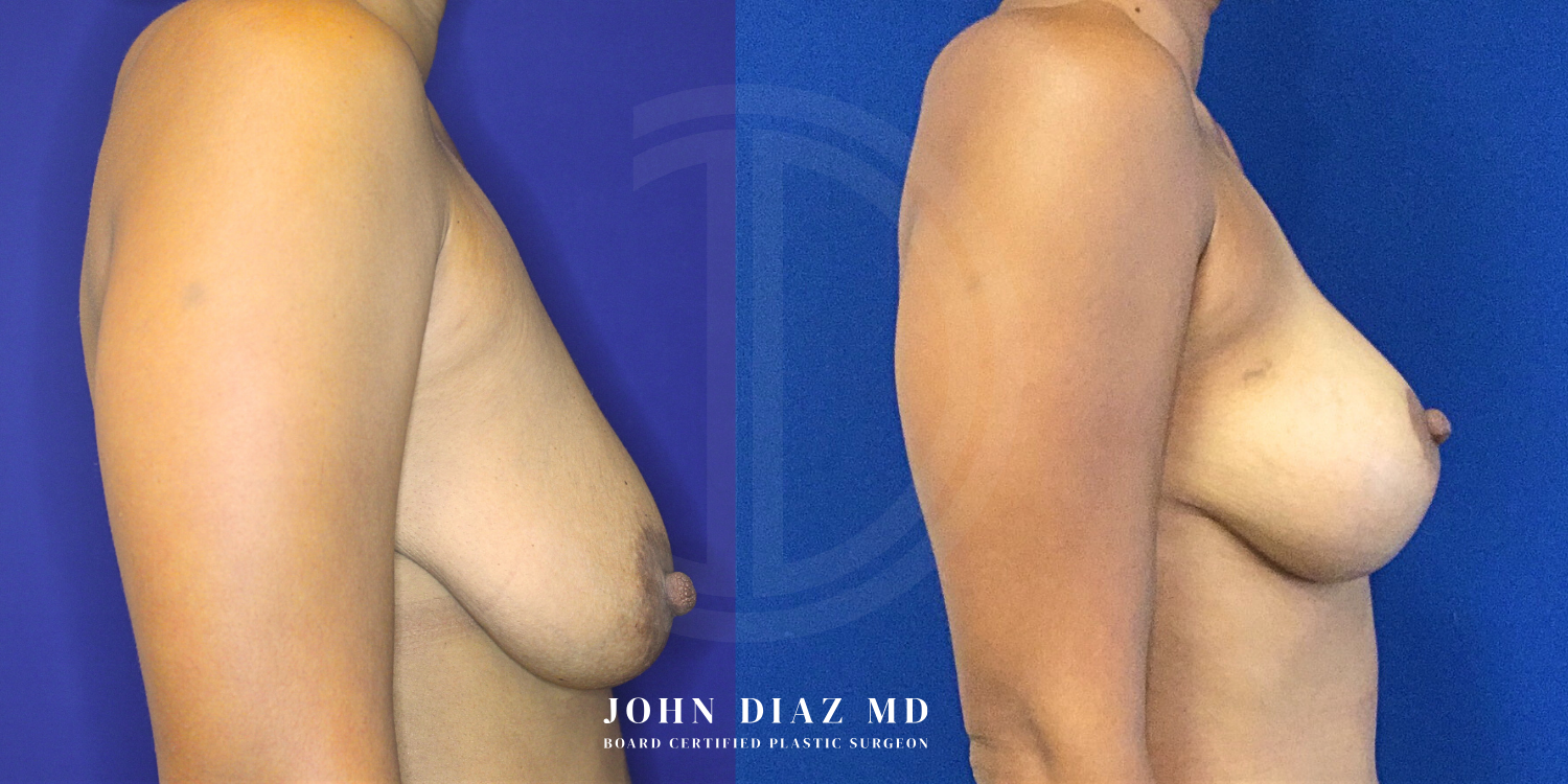 Dr John Diaz Before and After | Breast Augmentation