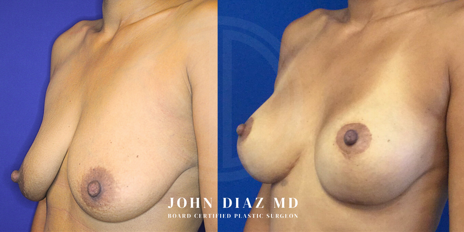 Dr John Diaz Before and After | Breast Augmentation