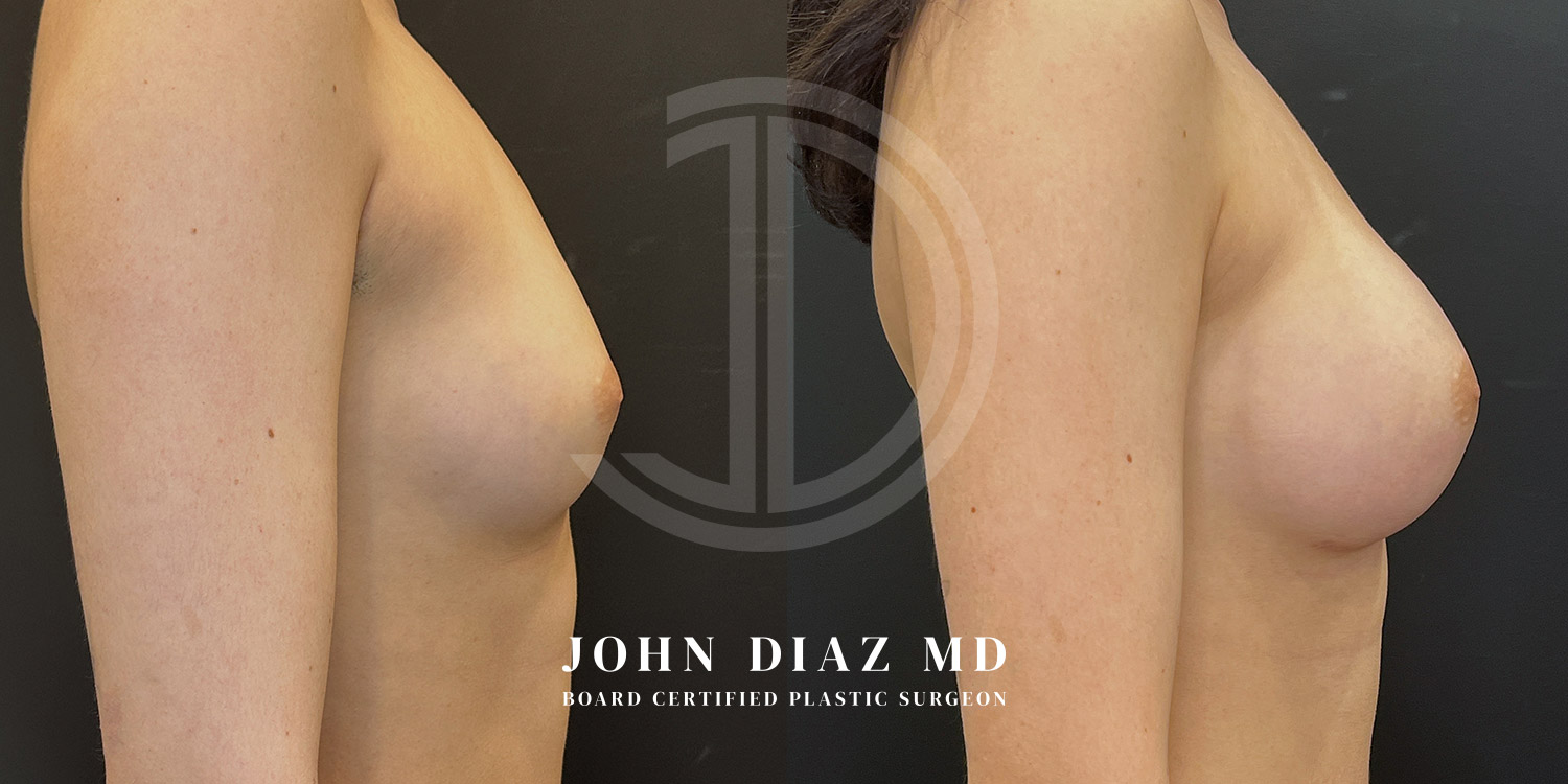 Dr John Diaz Before and After | Breast Augmentation