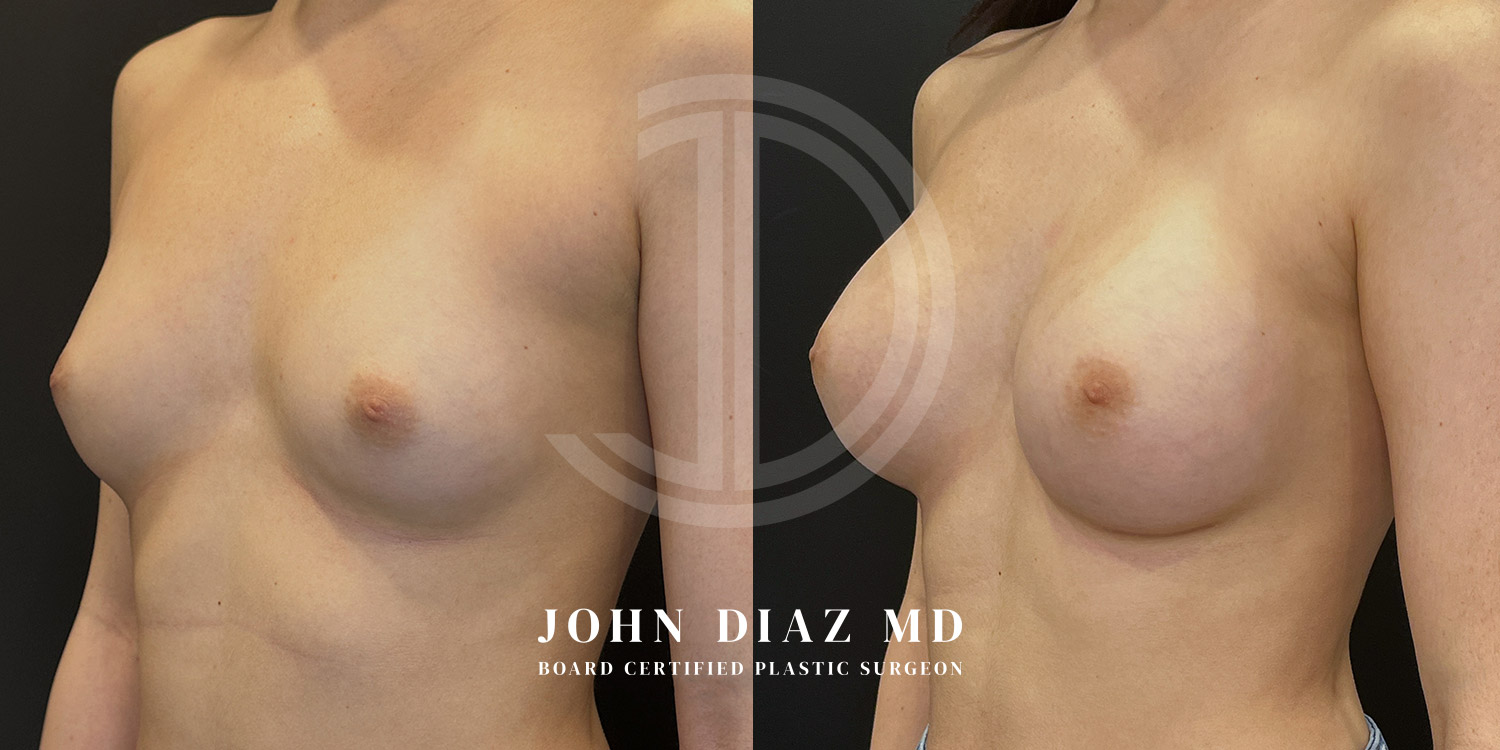 Dr John Diaz Before and After | Breast Augmentation