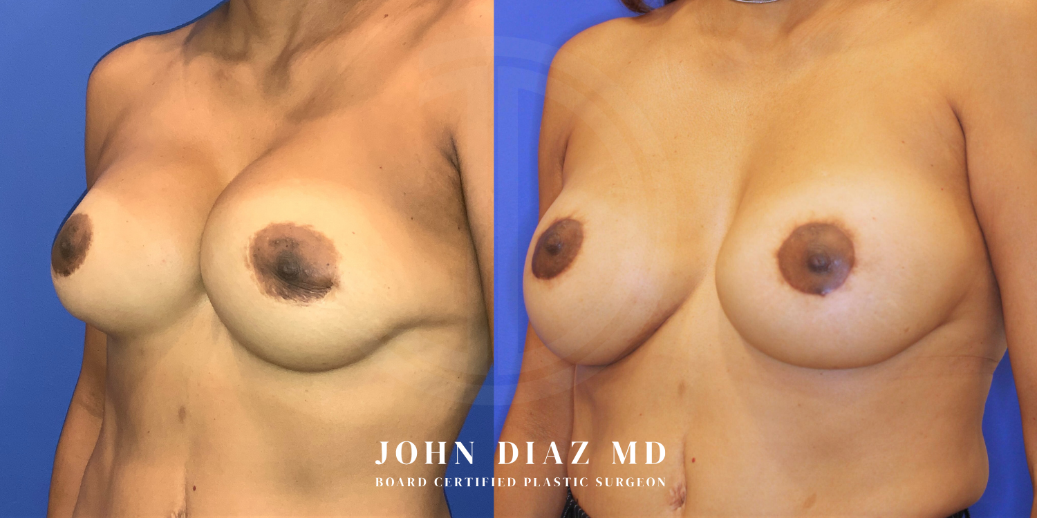 Dr John Diaz Before and After | Breast Revision, Capsular Contracture