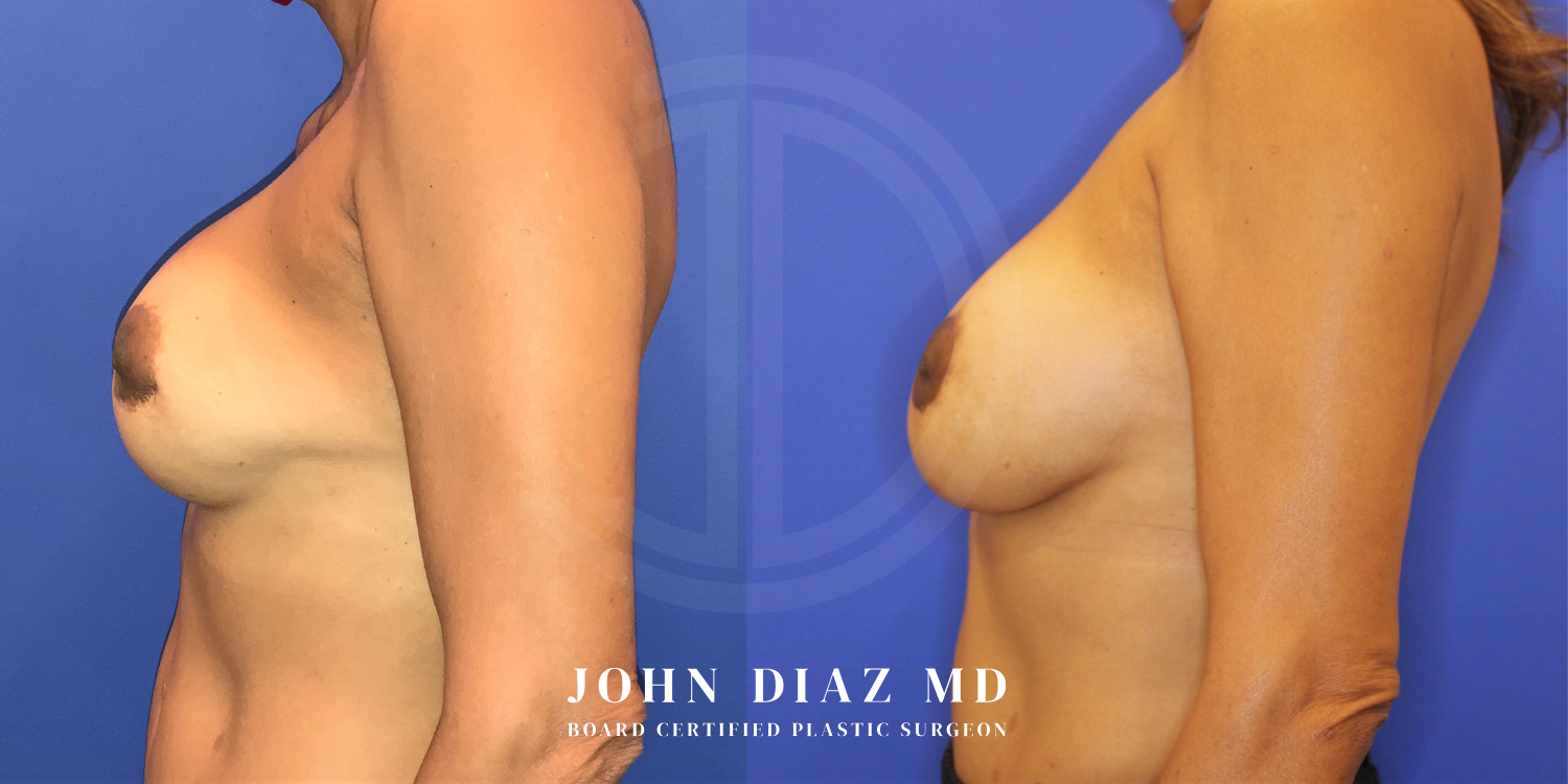 Dr John Diaz Before and After | Breast Revision, Capsular Contracture