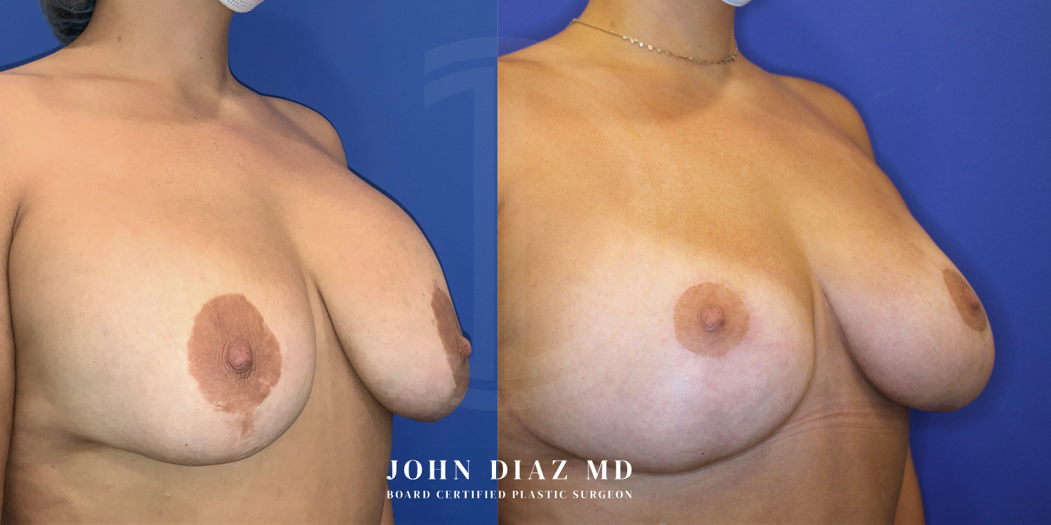 Dr John Diaz Before and After | Breast Revision, Capsular Contracture