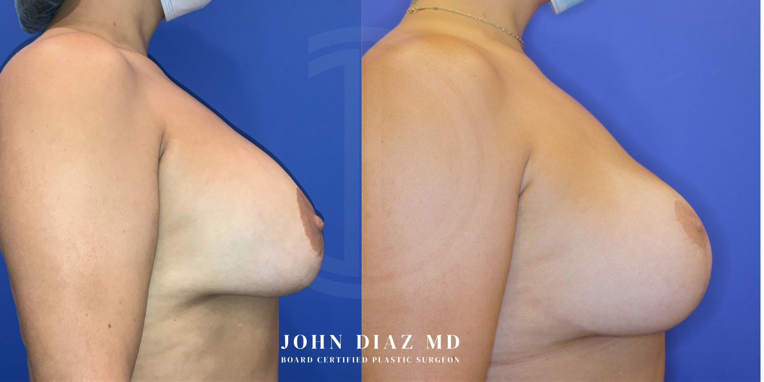 Dr John Diaz Before and After | Breast Revision, Capsular Contracture