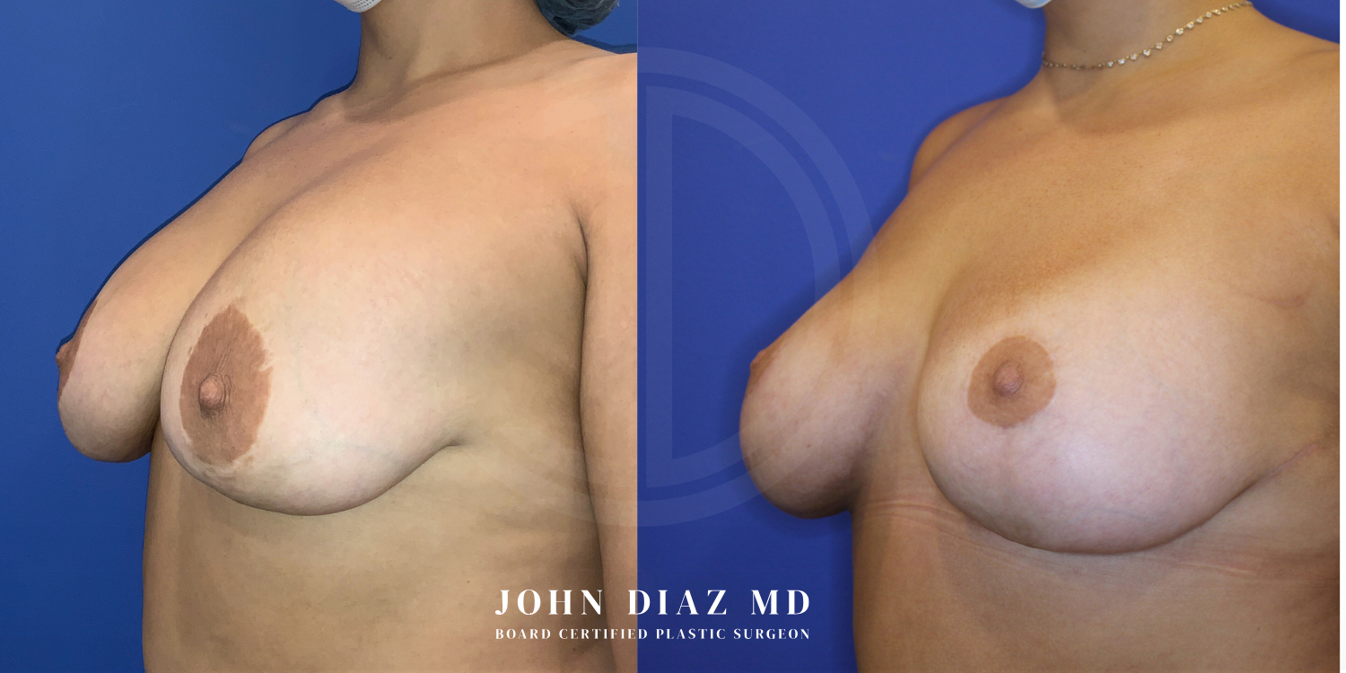 Dr John Diaz Before and After | Breast Revision, Capsular Contracture