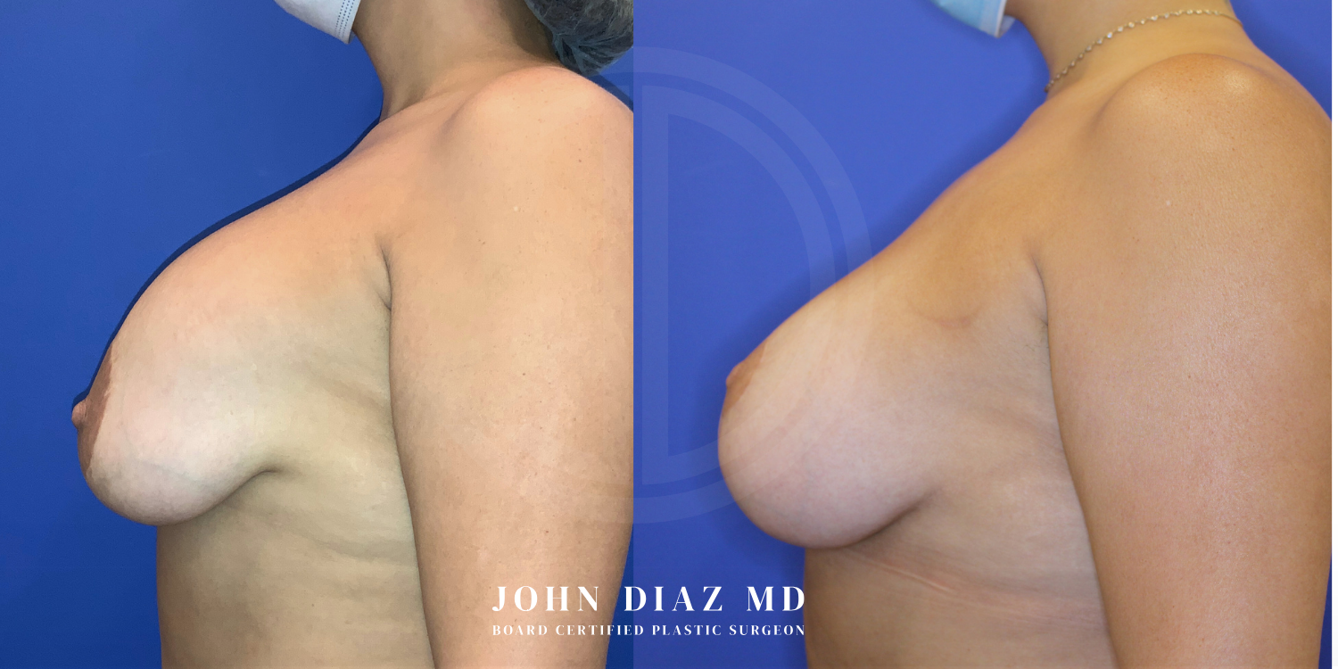 Dr John Diaz Before and After | Breast Revision, Capsular Contracture