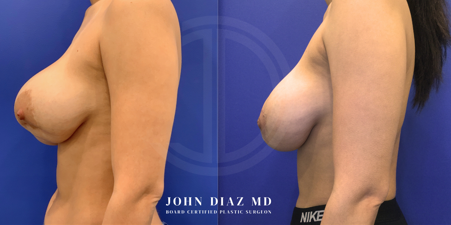 Dr John Diaz Before and After | Breast Revision, Capsular Contracture