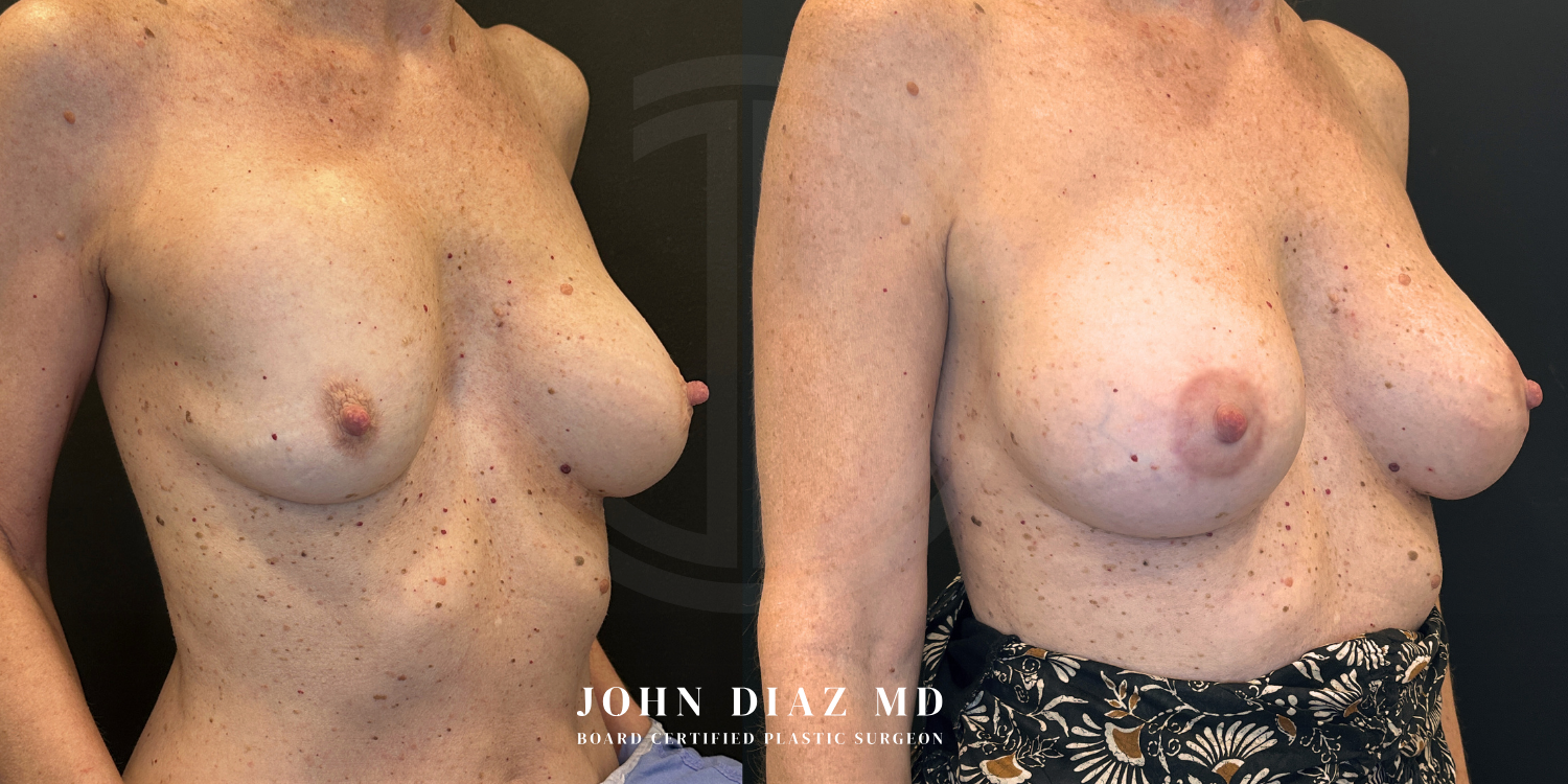 Dr John Diaz Before and After | Breast Revision, Capsular Contracture