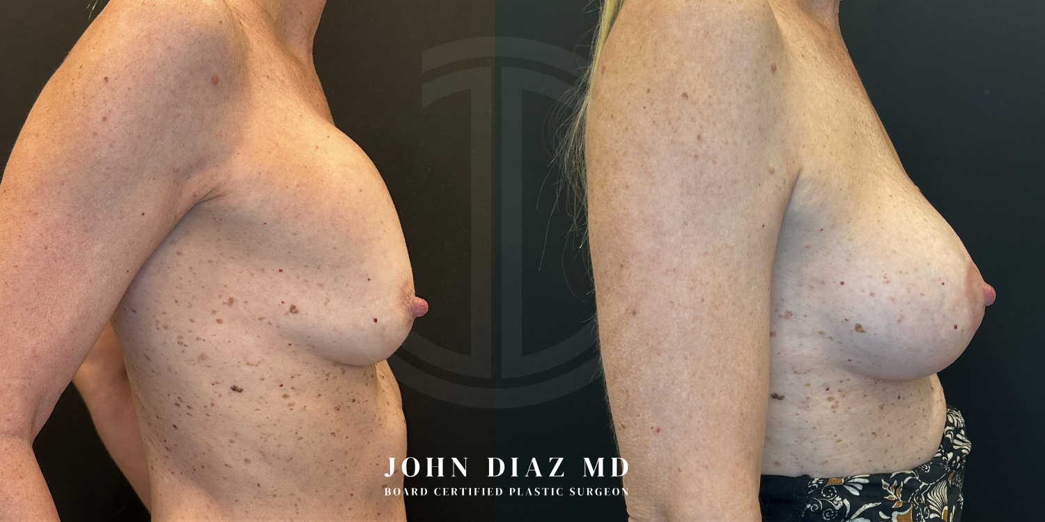Dr John Diaz Before and After | Breast Revision, Capsular Contracture