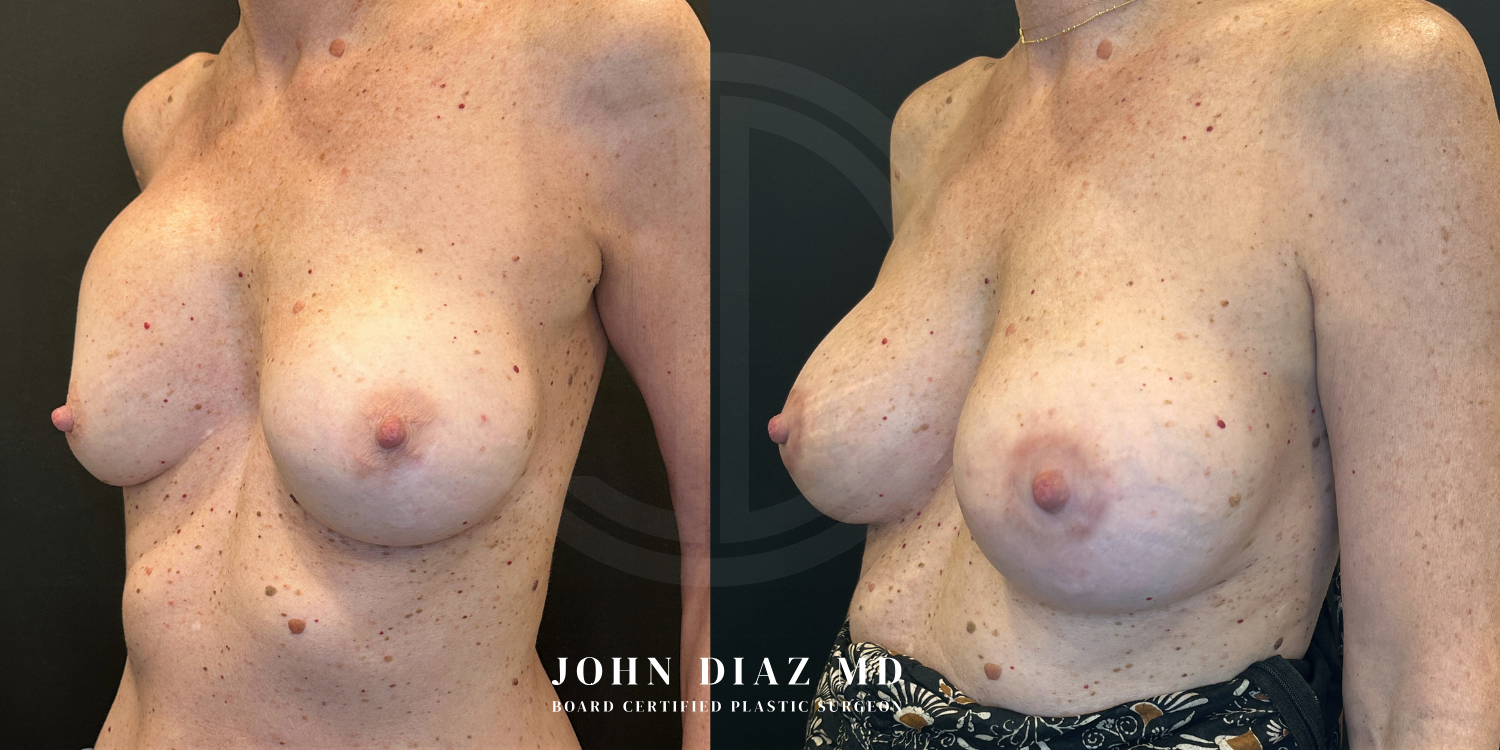 Dr John Diaz Before and After | Breast Revision, Capsular Contracture