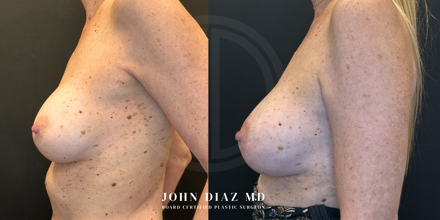 Dr John Diaz Before and After | Breast Revision, Capsular Contracture