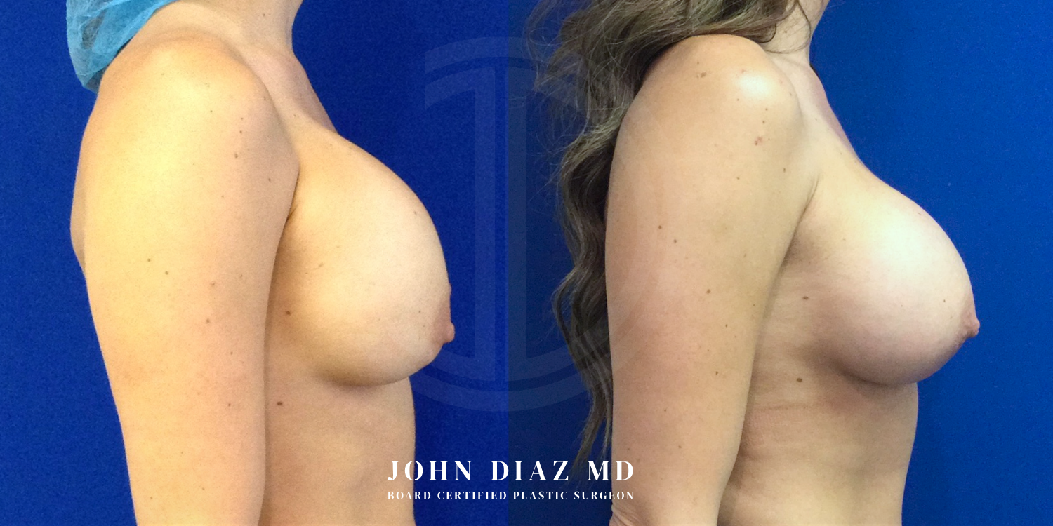 Dr John Diaz Before and After | Breast Revision, Capsular Contracture