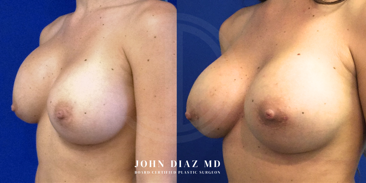 Dr John Diaz Before and After | Breast Revision, Capsular Contracture