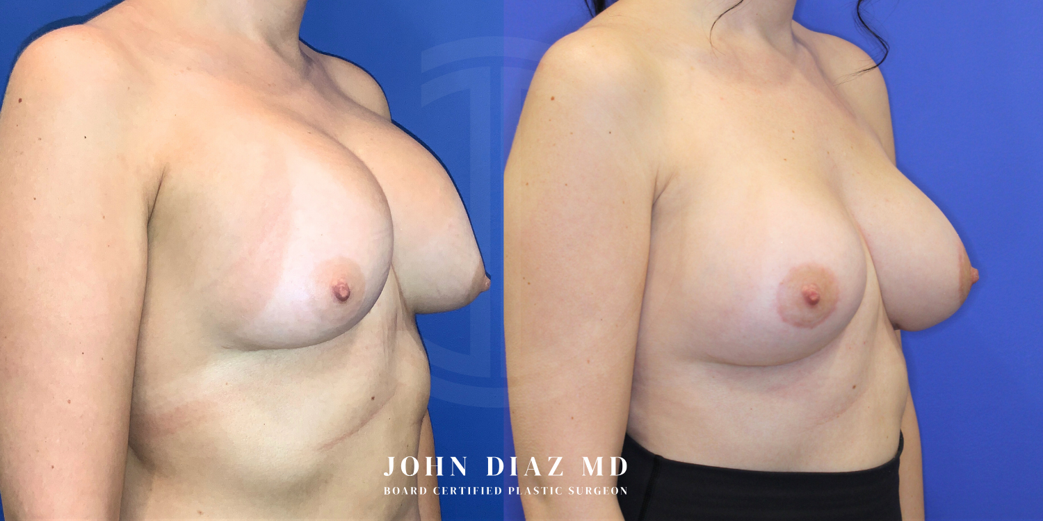 Dr John Diaz Before and After | Breast Revision, Capsular Contracture