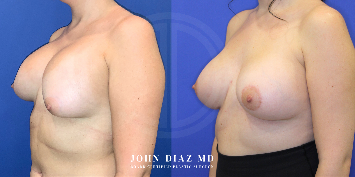 Dr John Diaz Before and After | Breast Revision, Capsular Contracture