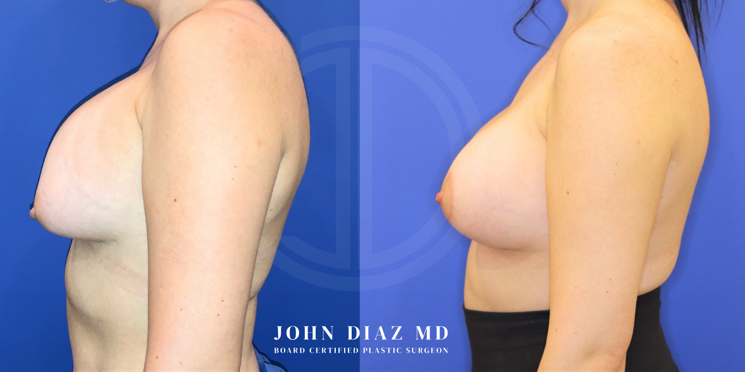 Dr John Diaz Before and After | Breast Revision, Capsular Contracture