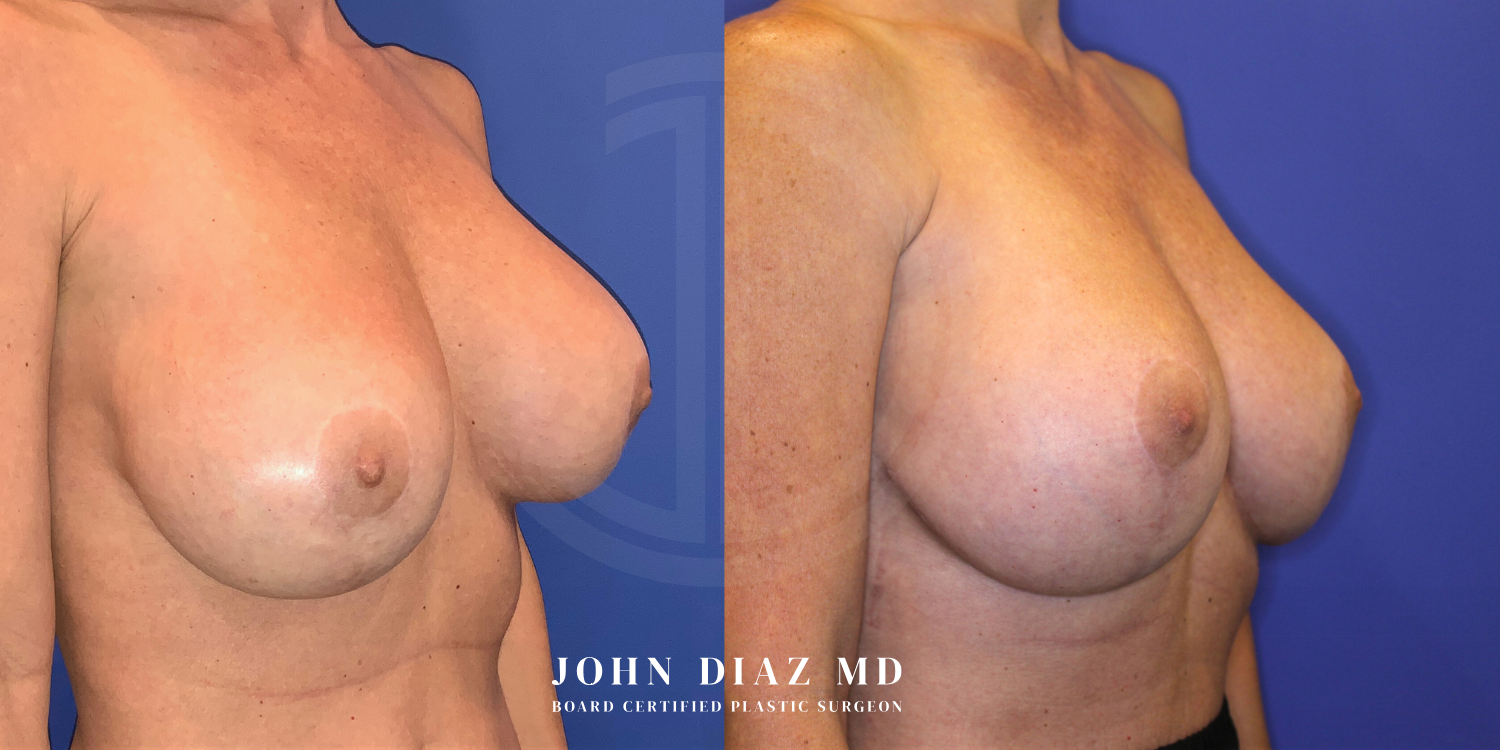 Dr John Diaz Before and After | Breast Revision, Capsular Contracture