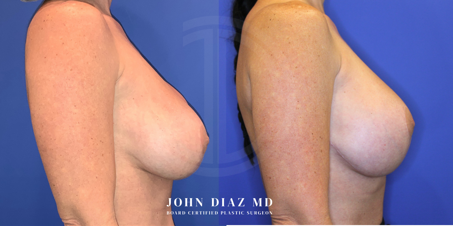 Dr John Diaz Before and After | Breast Revision, Capsular Contracture