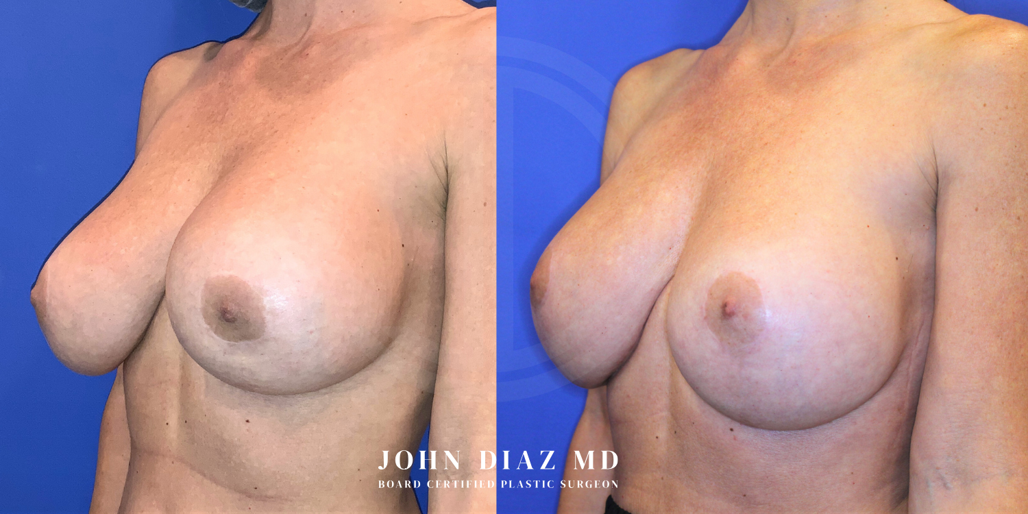 Dr John Diaz Before and After | Breast Revision, Capsular Contracture