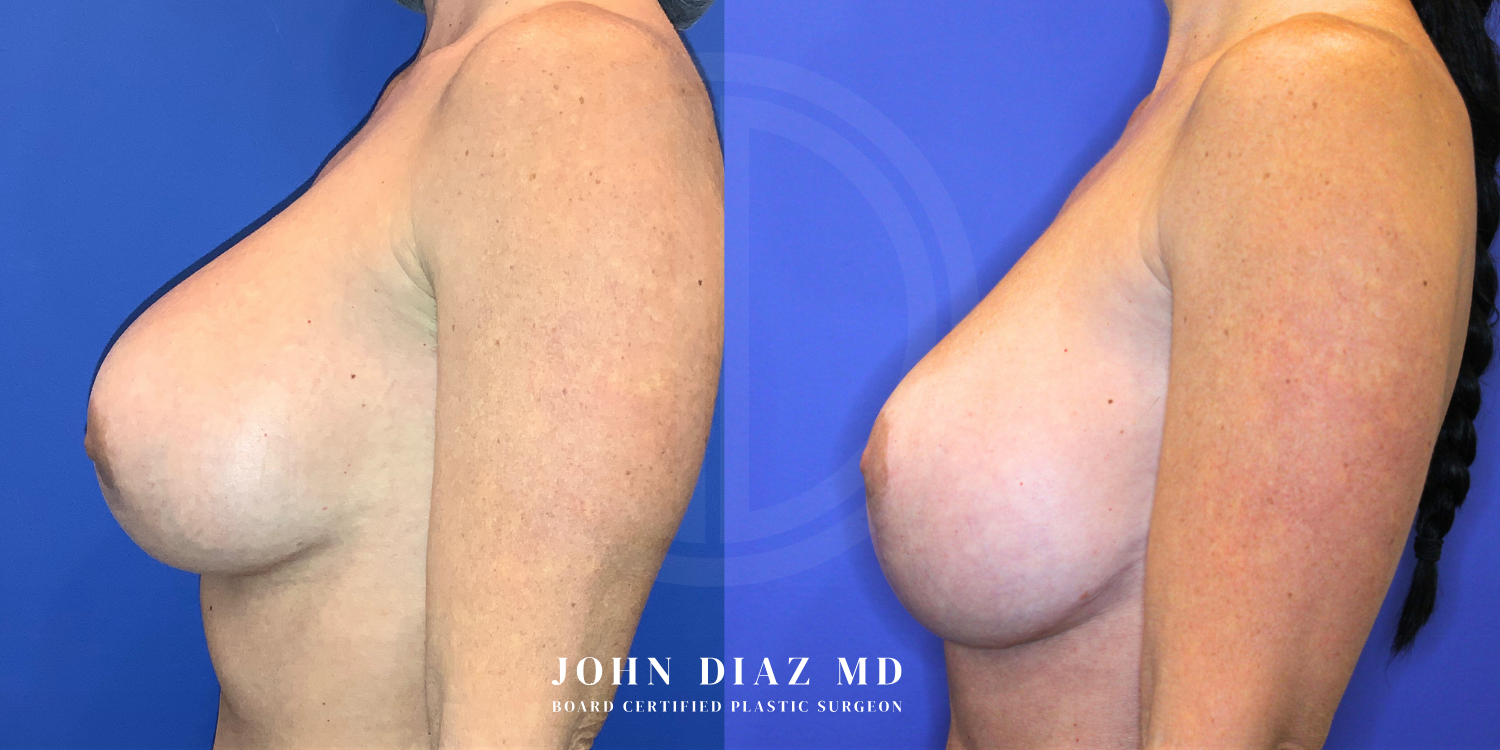 Dr John Diaz Before and After | Breast Revision, Capsular Contracture