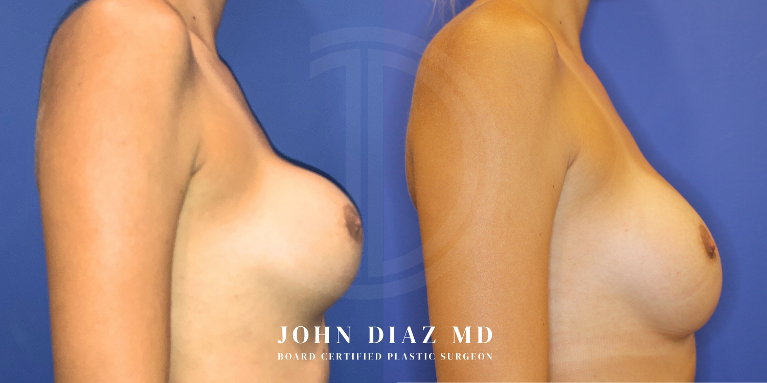 Dr John Diaz Before and After | Breast Revision, Capsular Contracture