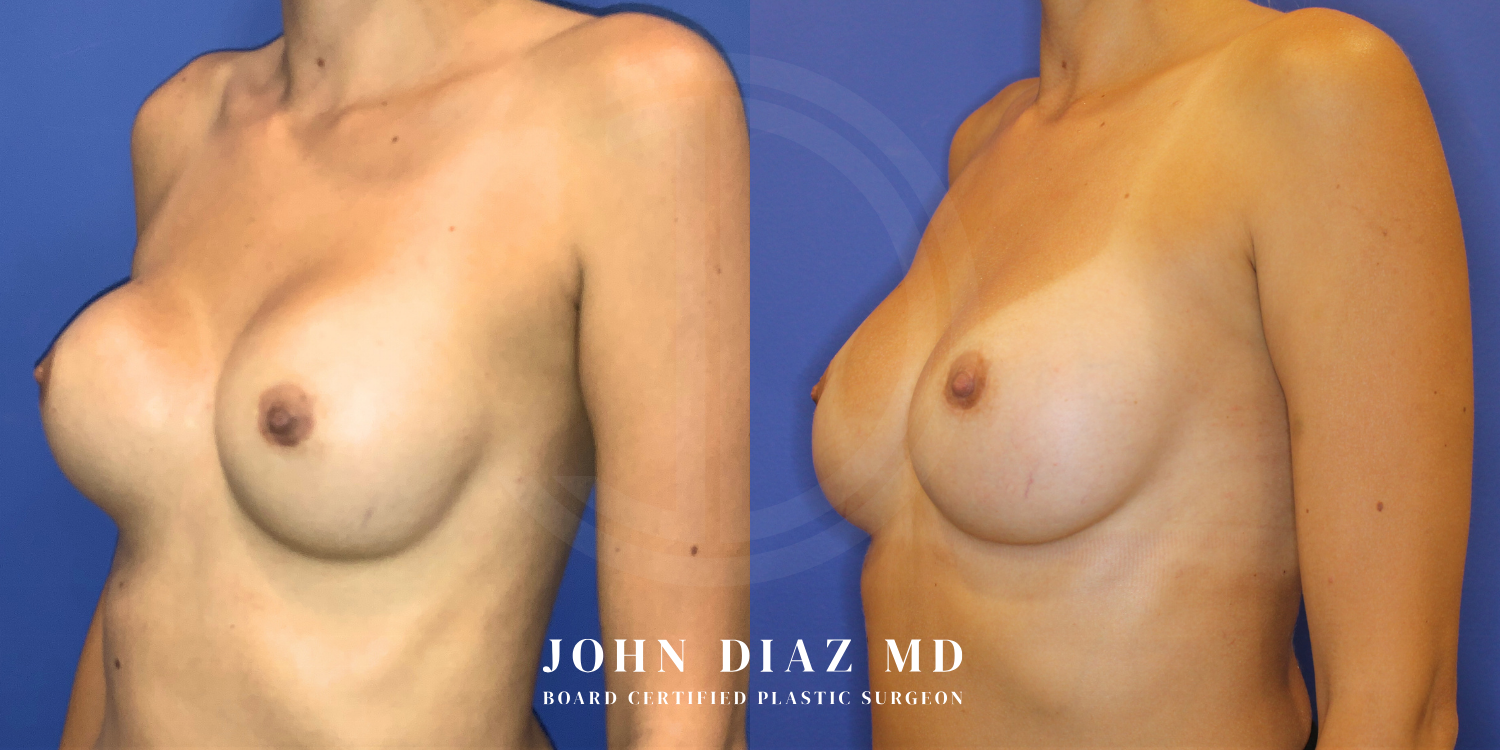 Dr John Diaz Before and After | Breast Revision, Capsular Contracture