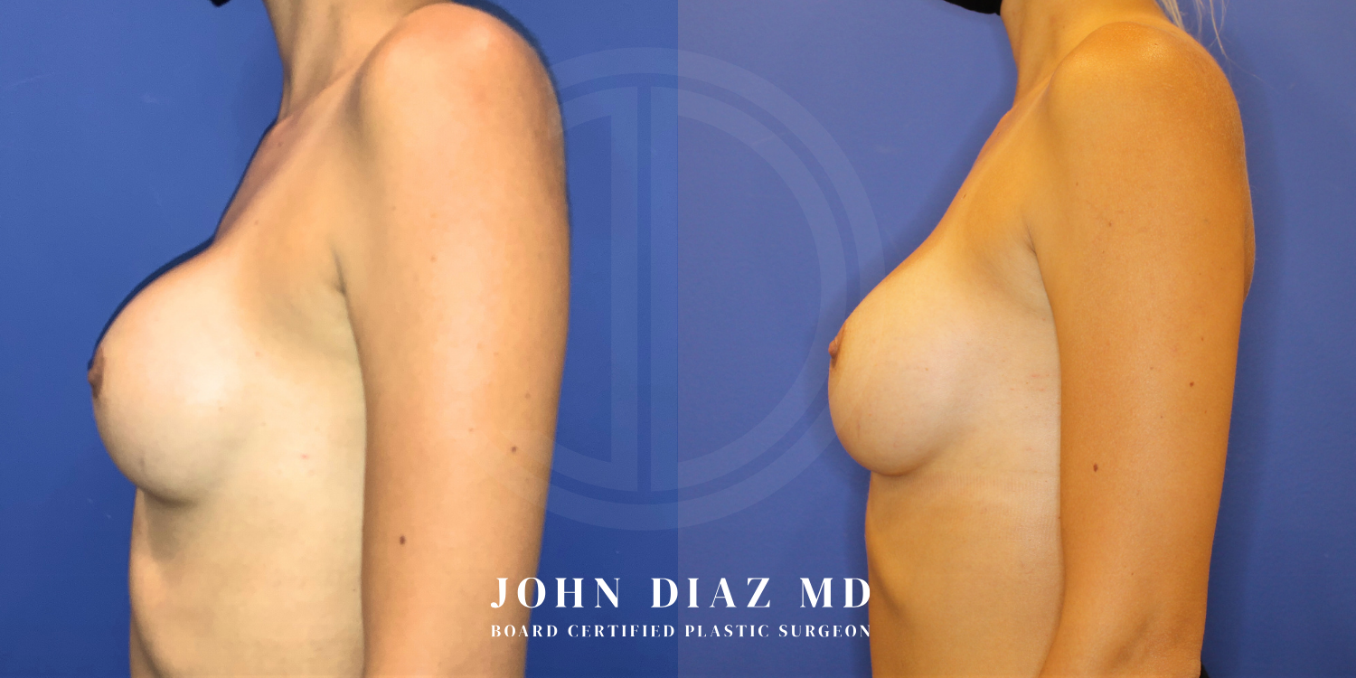 Dr John Diaz Before and After | Breast Revision, Capsular Contracture