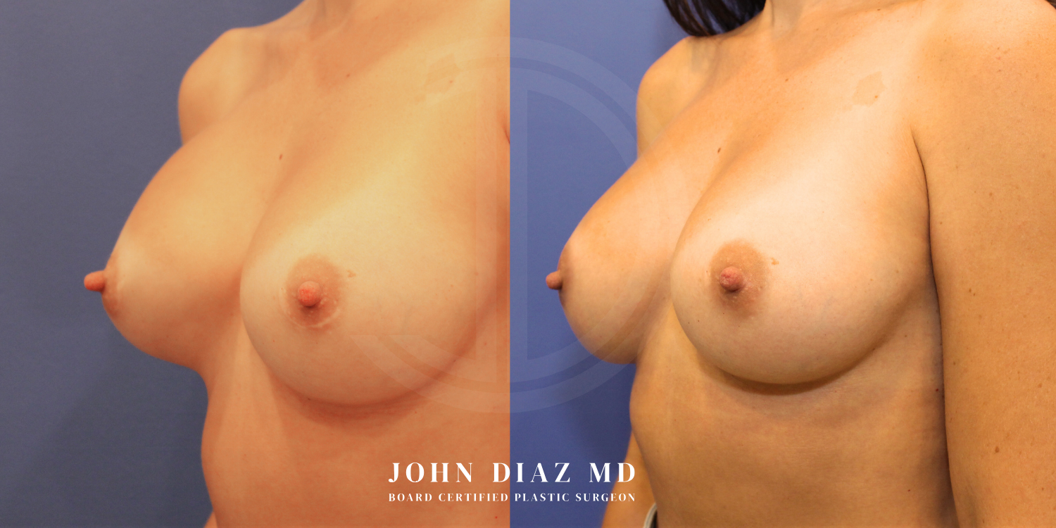 Dr John Diaz Before and After | Breast Revision, Capsular Contracture