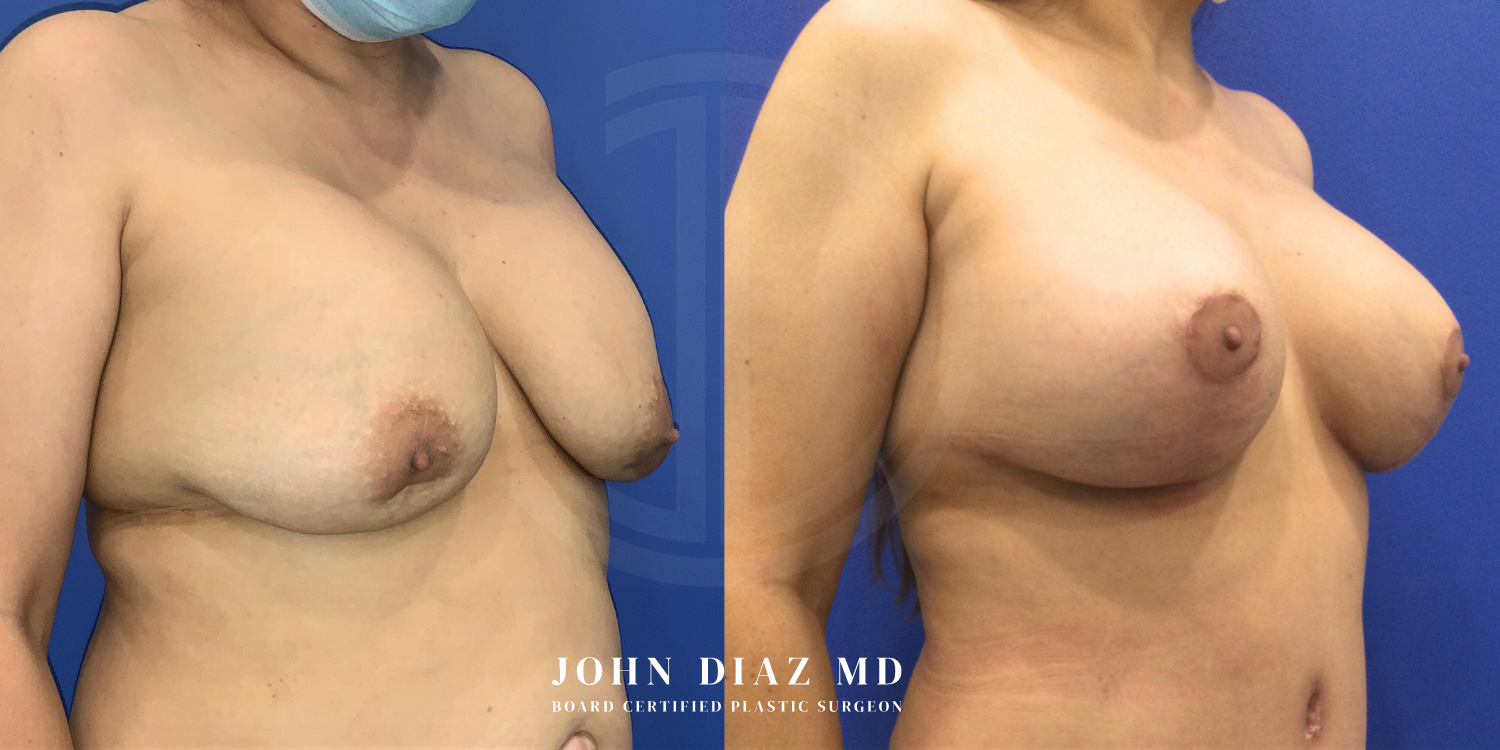 Dr John Diaz Before and After | Breast Revision, Capsular Contracture