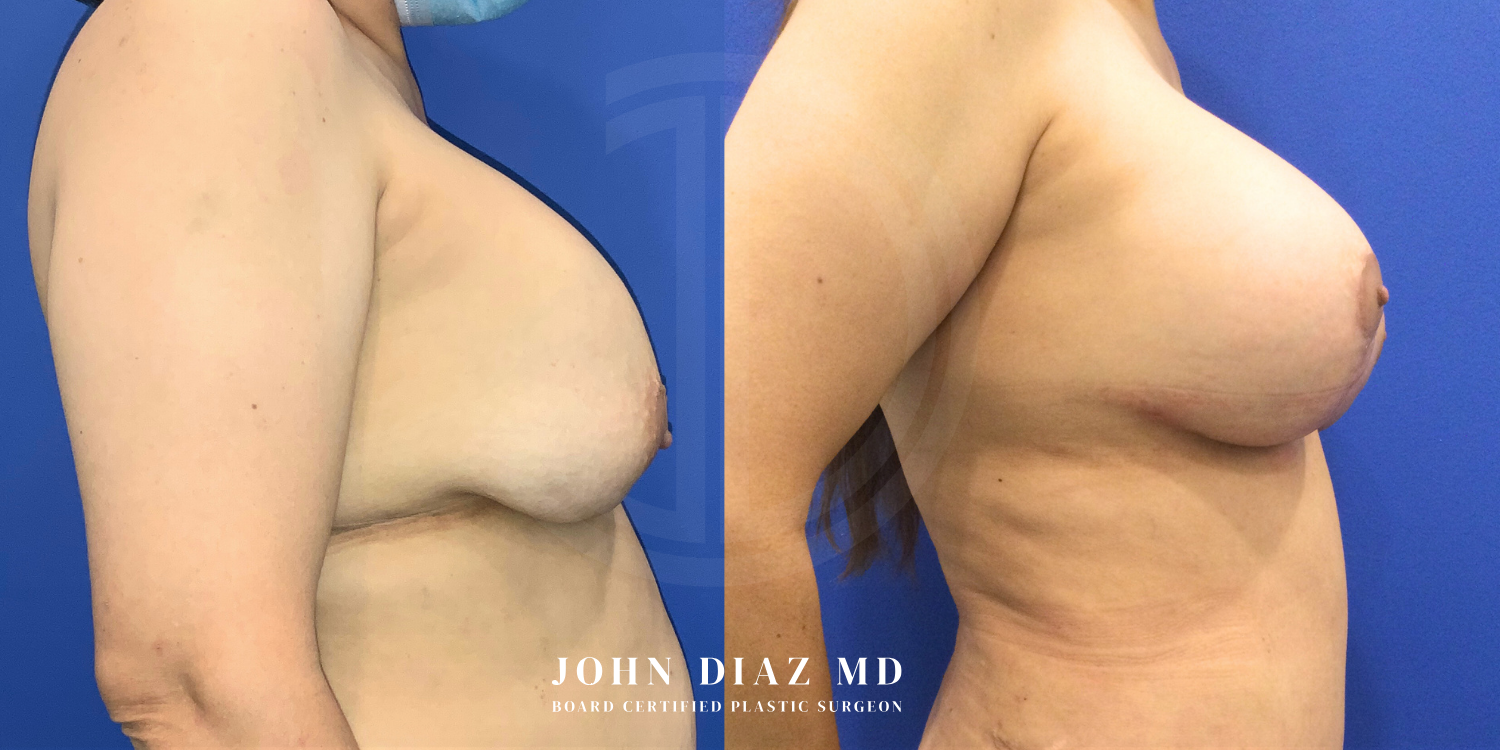 Dr John Diaz Before and After | Breast Revision, Capsular Contracture