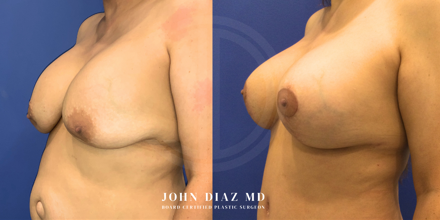 Dr John Diaz Before and After | Breast Revision, Capsular Contracture