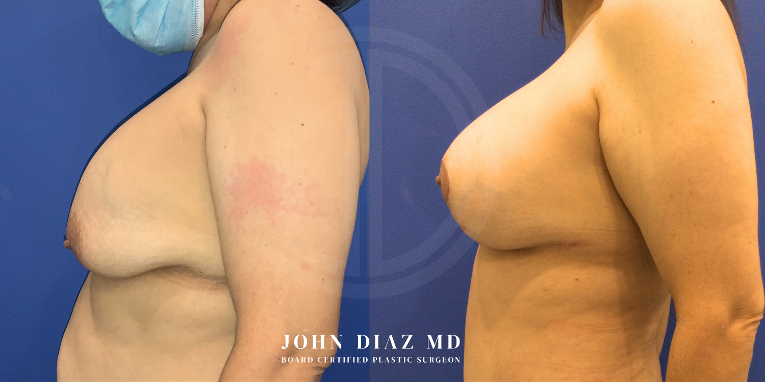 Dr John Diaz Before and After | Breast Revision, Capsular Contracture