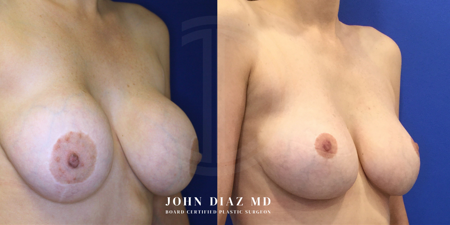 Dr John Diaz Before and After | Breast Revision, Capsular Contracture