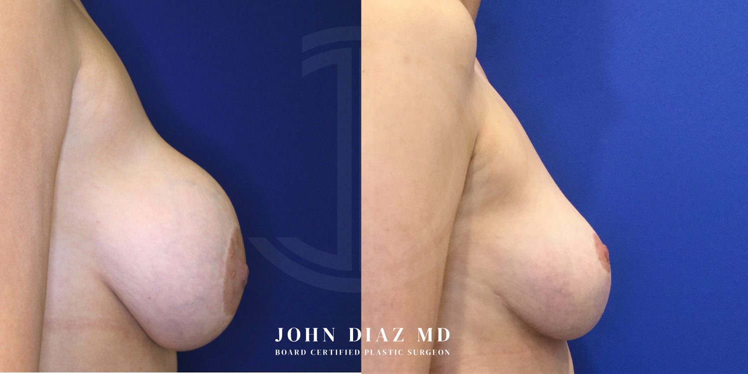 Dr John Diaz Before and After | Breast Revision, Capsular Contracture