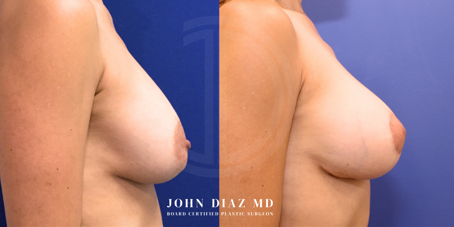 Dr John Diaz Before and After | Breast Revision, Capsular Contracture