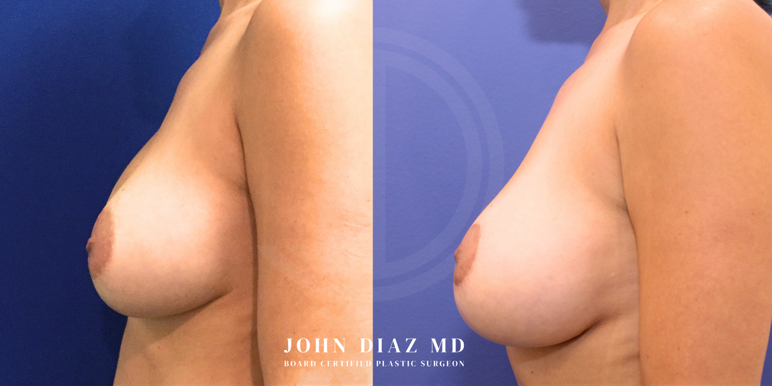 Dr John Diaz Before and After | Breast Revision, Capsular Contracture