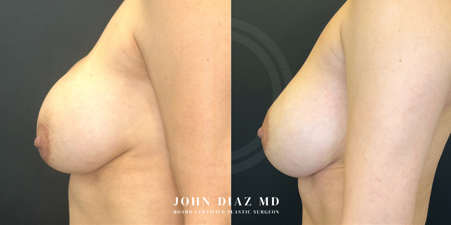 Dr John Diaz Before and After | Breast Revision, Capsular Contracture