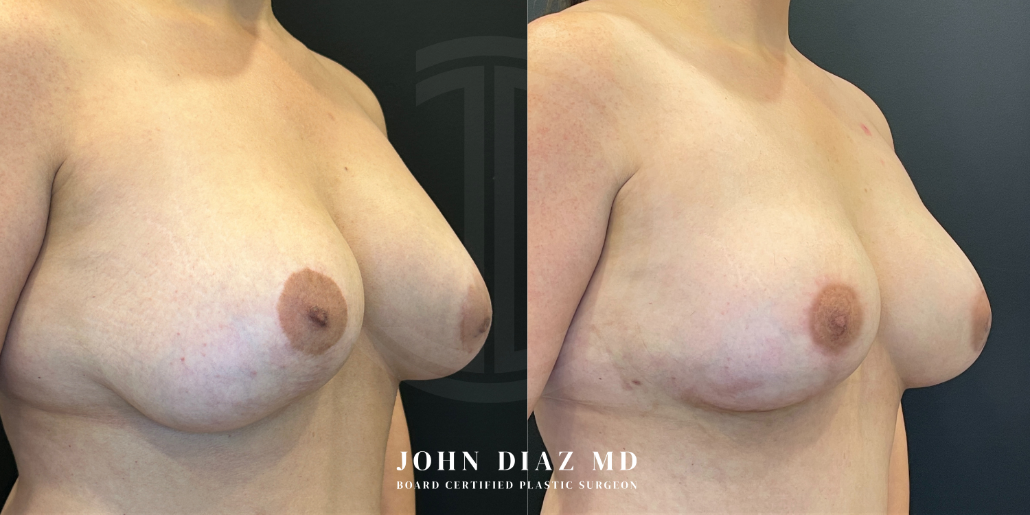 Dr John Diaz Before and After | Breast Revision, Capsular Contracture