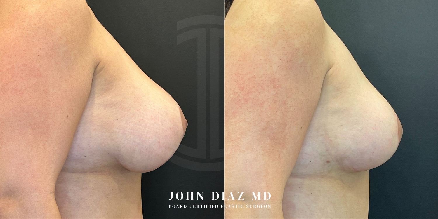 Dr John Diaz Before and After | Breast Revision, Capsular Contracture