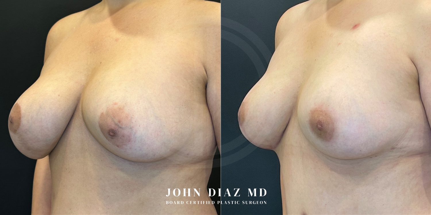 Dr John Diaz Before and After | Breast Revision, Capsular Contracture