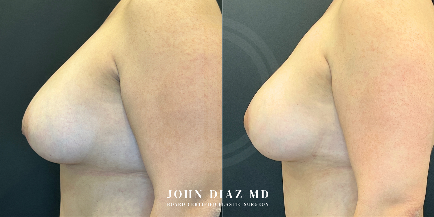 Dr John Diaz Before and After | Breast Revision, Capsular Contracture