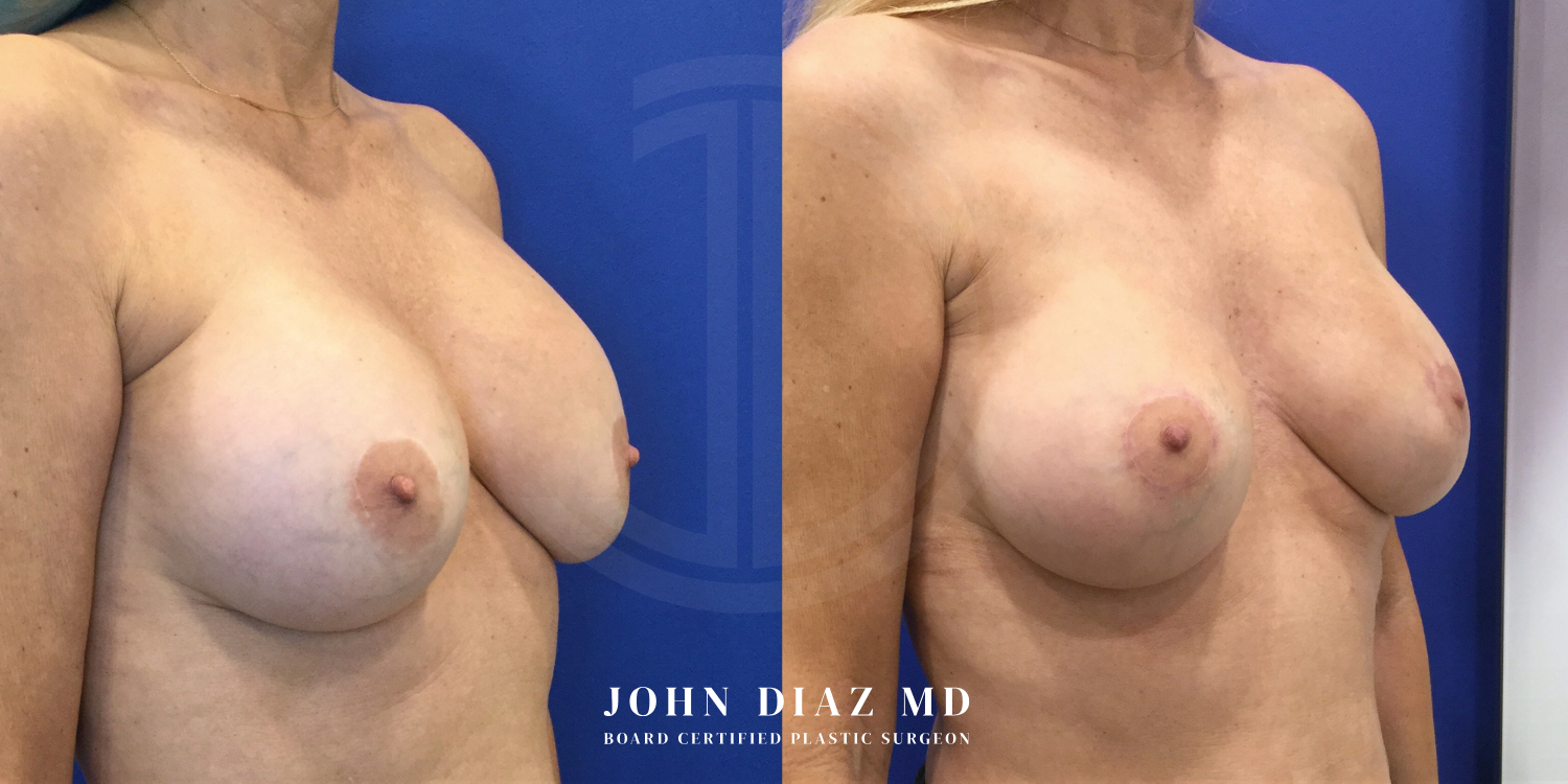 Dr John Diaz Before and After | Breast Revision, Capsular Contracture
