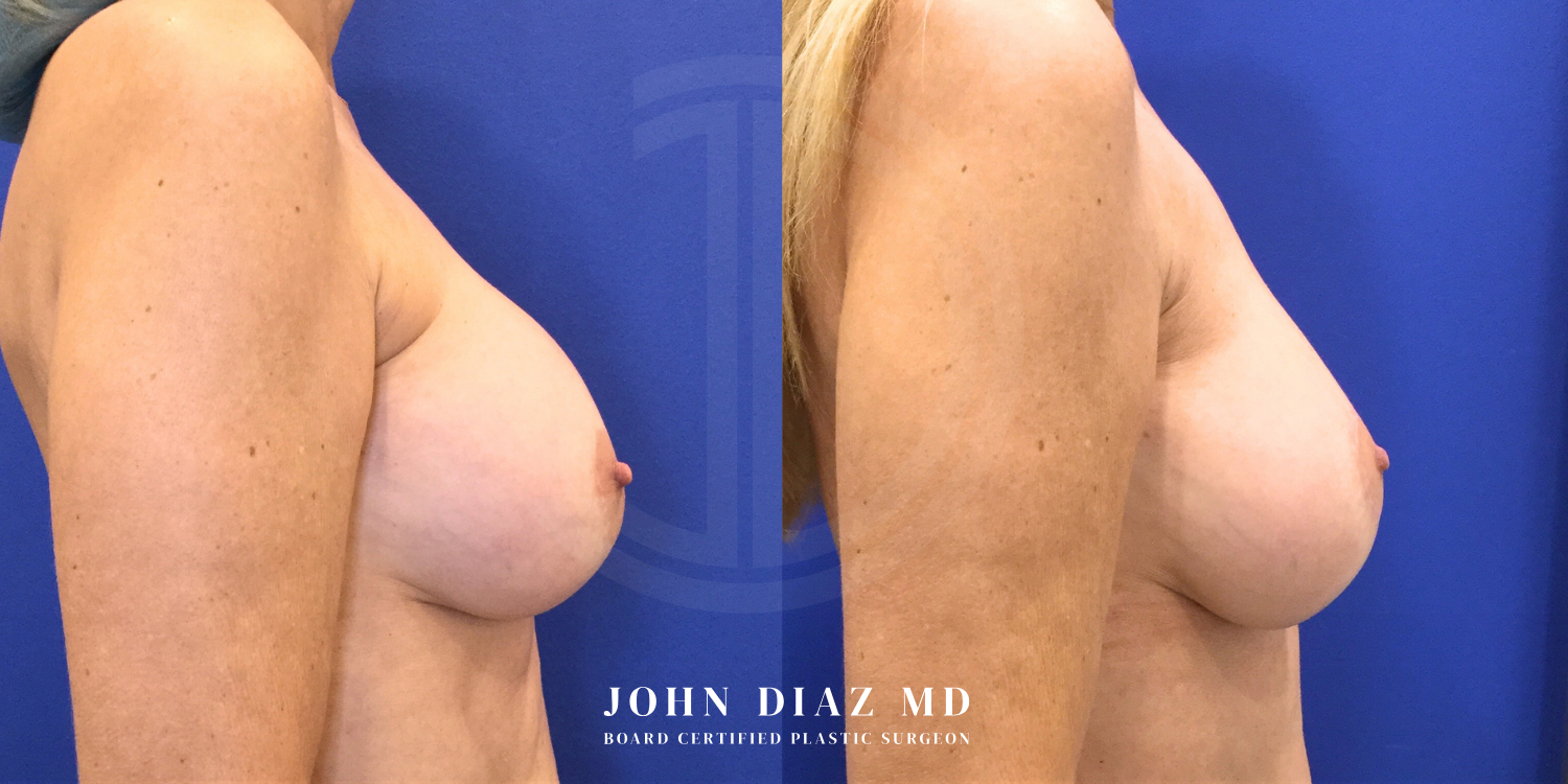 Dr John Diaz Before and After | Breast Revision, Capsular Contracture