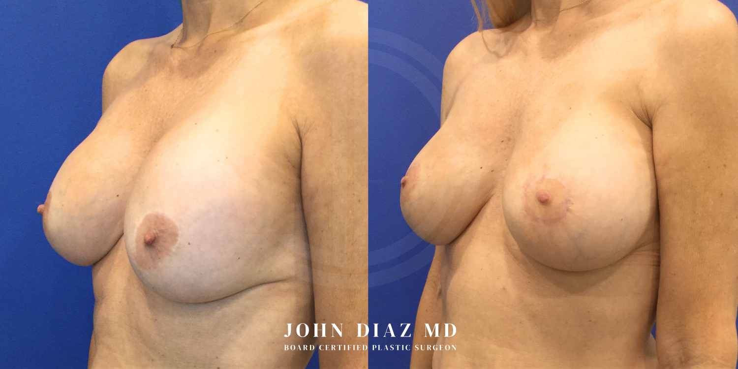 Dr John Diaz Before and After | Breast Revision, Capsular Contracture