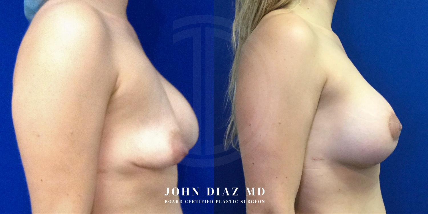Dr John Diaz Before and After | Breast Revision, Capsular Contracture