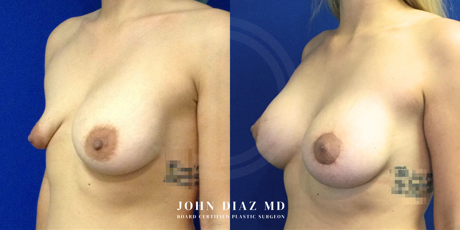 Dr John Diaz Before and After | Breast Revision, Capsular Contracture