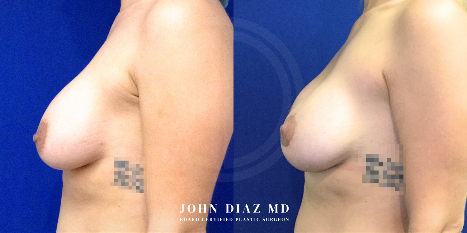 Dr John Diaz Before and After | Breast Revision, Capsular Contracture