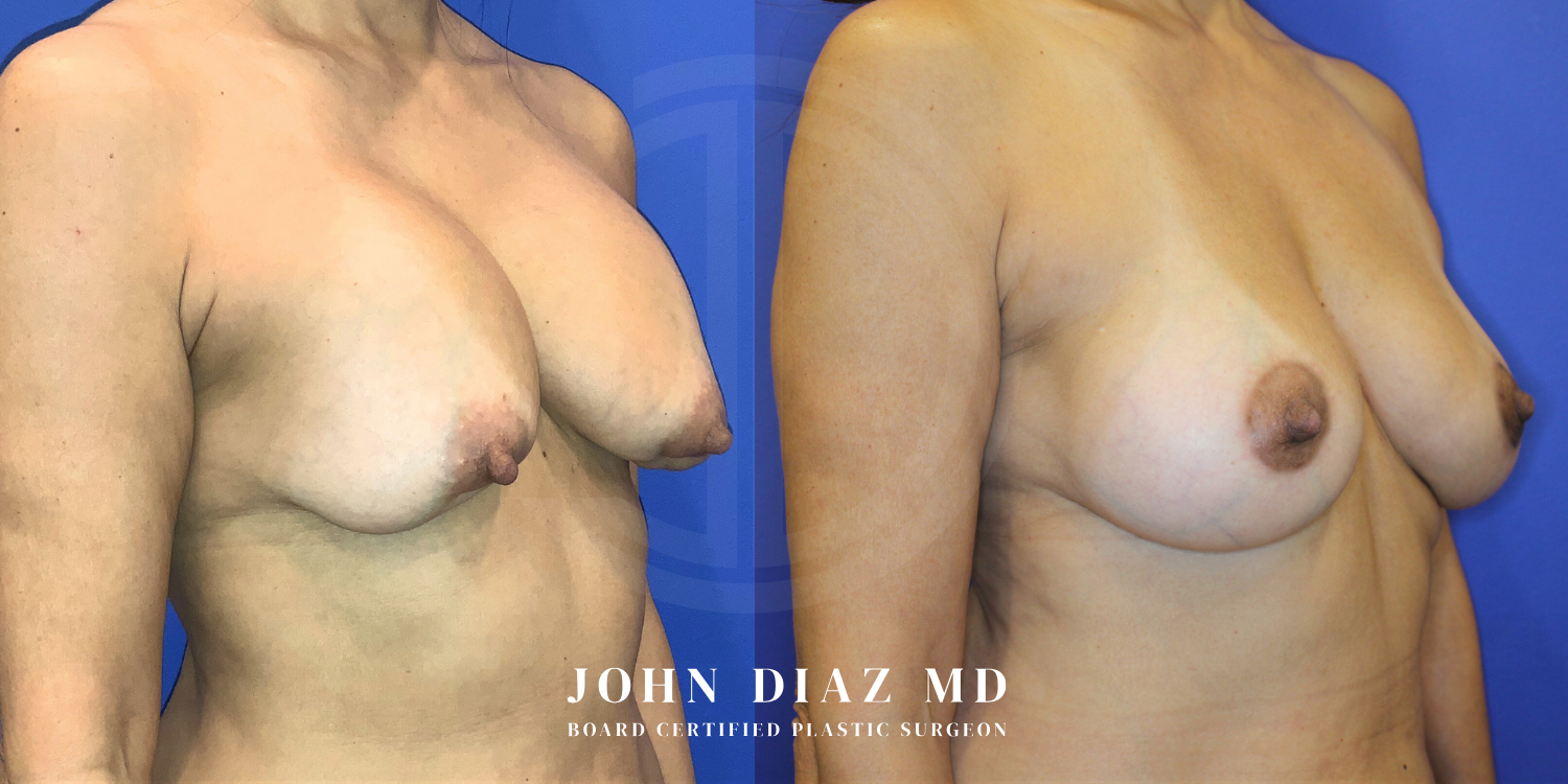 Dr John Diaz Before and After | Breast Revision, Capsular Contracture