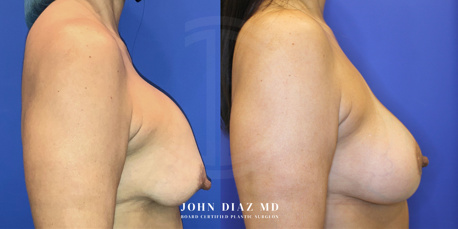 Dr John Diaz Before and After | Breast Revision, Capsular Contracture